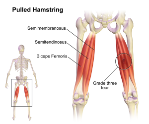 Hamstring-Strain