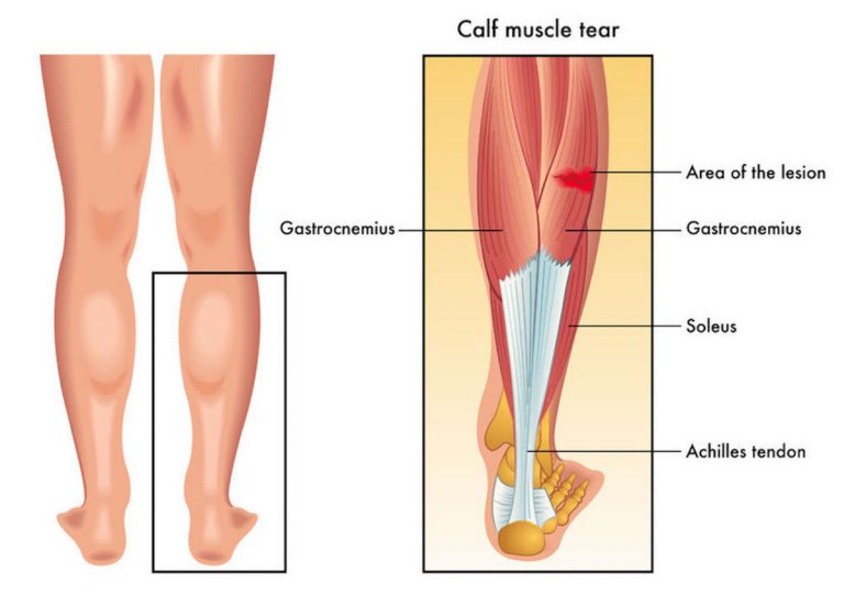 calf-strain-holistic-bodyworks