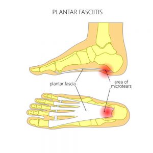 Image depicting the Plantar Fascia attachments and the location of pain in Plantar Fasciitis