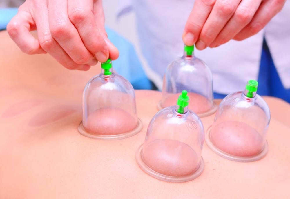Image depicting myofascial cupping being performed on a woman's back