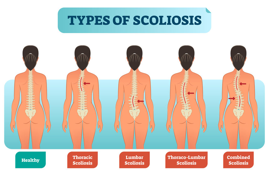 Types of scoliosis medical anatomical vector illustration diagram with spine curvatures.