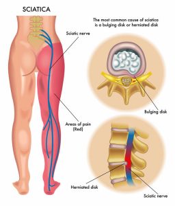 Image depicting the main causes of sciatica