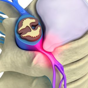 Image depicting a lumbar disc prolapse
