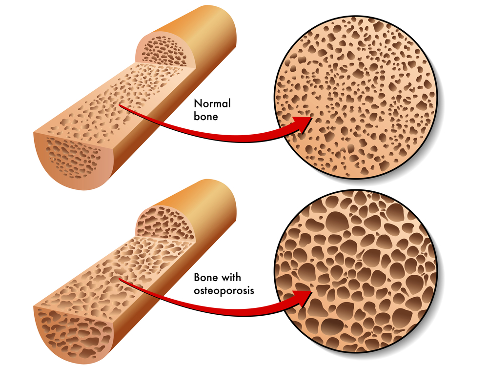 Image showing the process of Osteoporosis