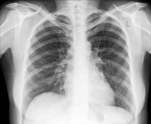 Image of a human chest X-ray